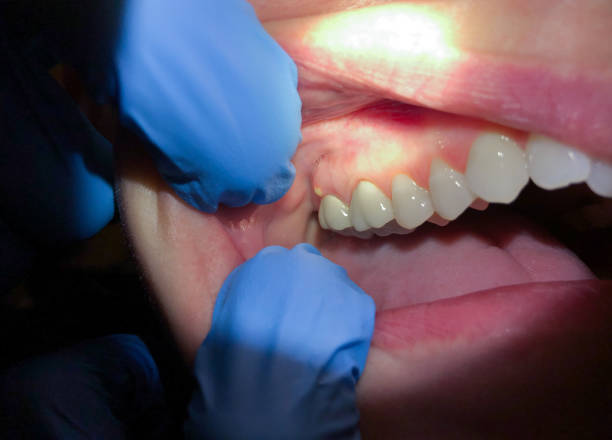 Best Emergency Denture Repair in Tecumseh, MI